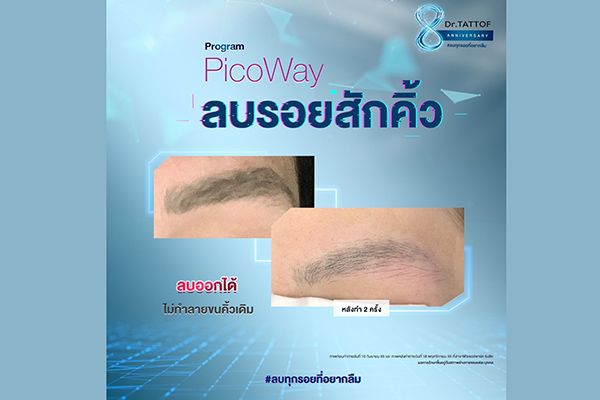 ข่าวความงาม - แก้คิ้วที่พังให้กลับมาปัง ด้วยนวัตกรรมการลบรอยสักคิ้วที่ไม่ทิ้งรอยแผลเป็น